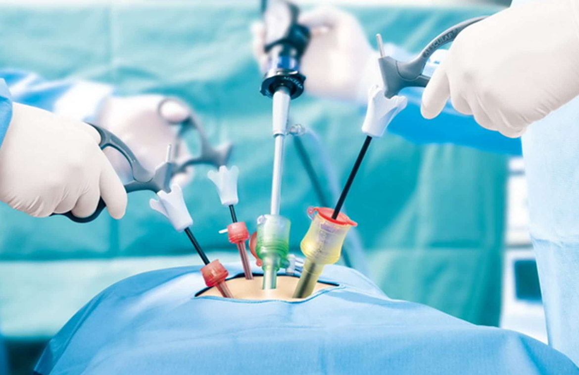 laparoscopic cholecystectomy surgery