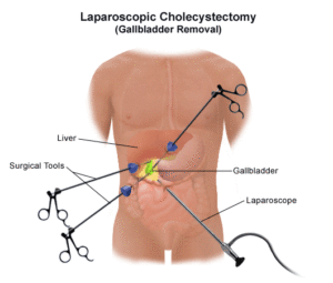 laparoscopic surgery Indore