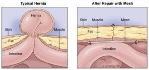 hernia surgeons near me