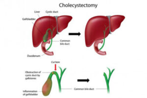 laparoscopic surgery Indore
