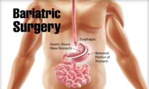 laparoscopic surgery Indore