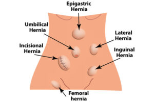 laparoscopic surgery Indore