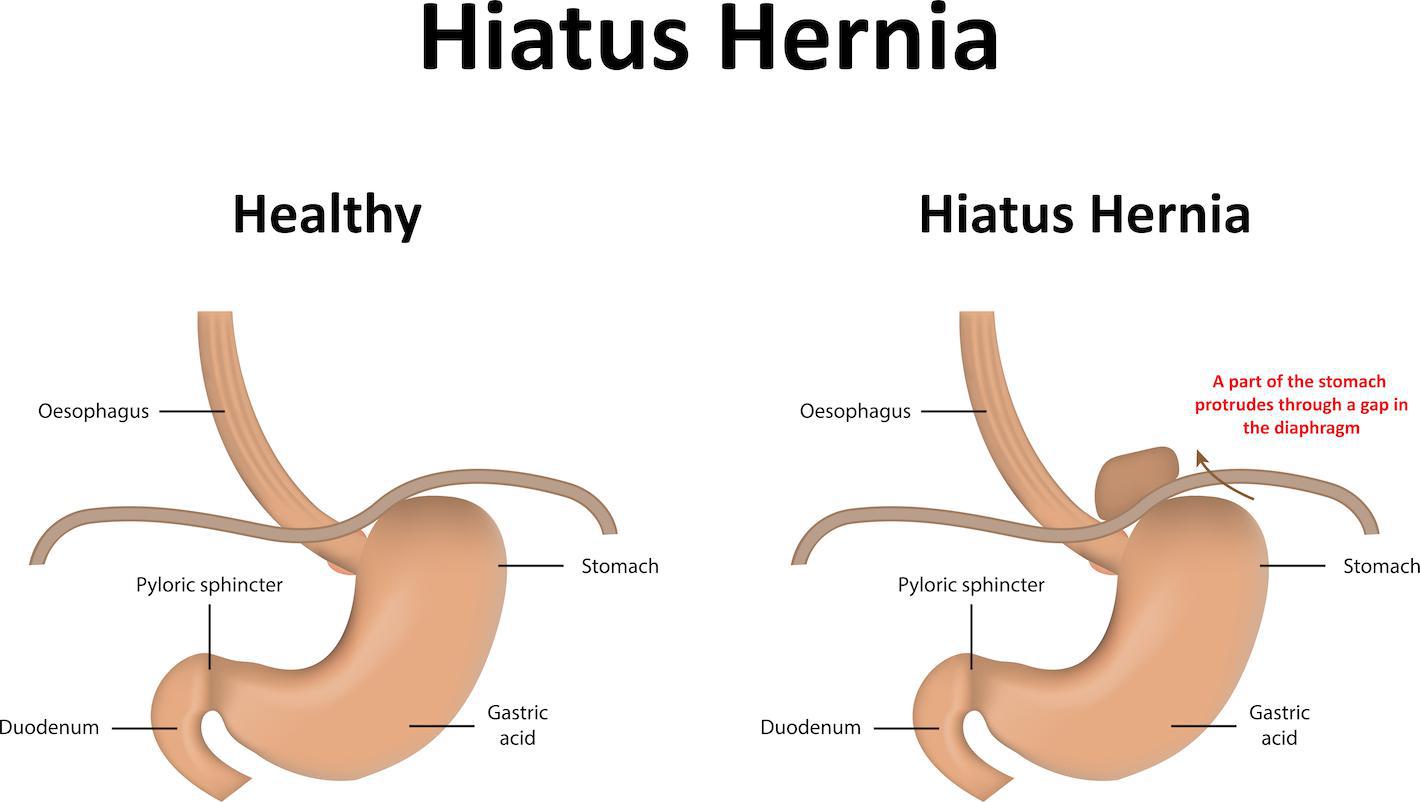Treatment for Hiatus Hernia Specialist