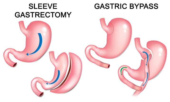 gastro surgeon Indore, mini gastric bypass surgery in indore