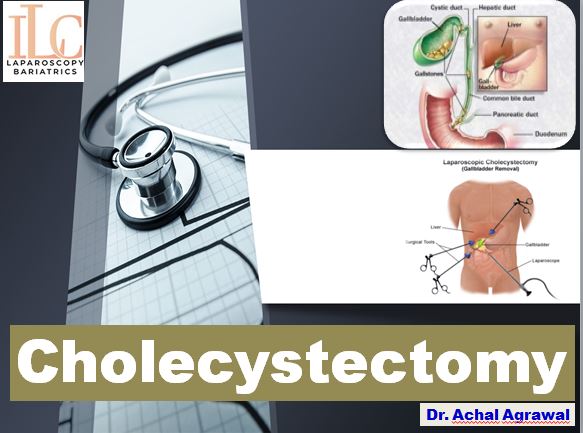 laparoscopic cholecystectomy surgery