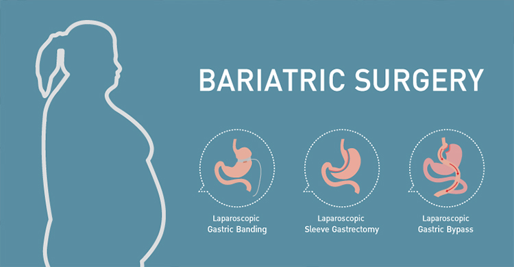 bariatric surgeon Indore | weight loss surgery Indore, bariatric surgeon indore, bariatric surgery clinics in indore