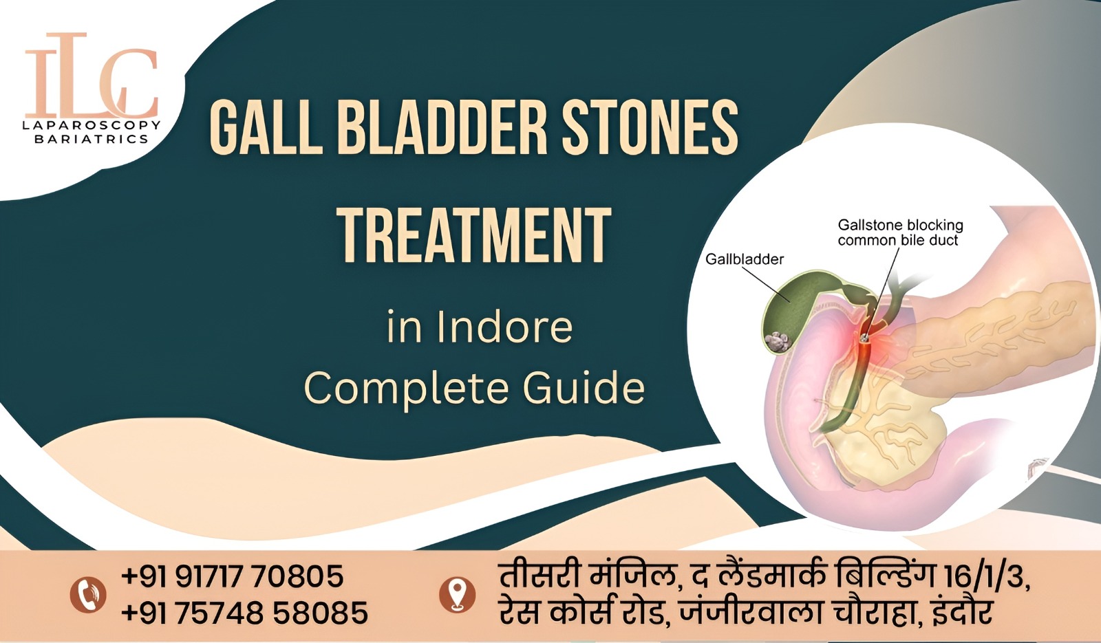 Gall Bladder Stones Treatment in Indore