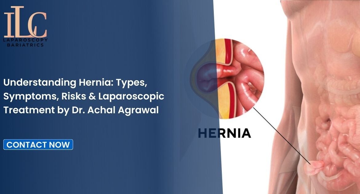 Understanding Hernia Types, Symptoms, Risks & Laparoscopic Treatment by Dr. Achal Agrawal