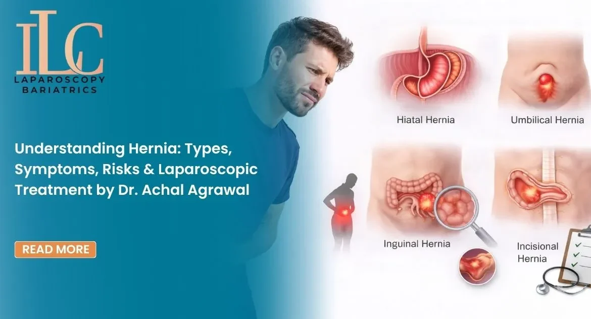Understanding Hernia Types, Symptoms, Risks & Laparoscopic Treatment by Dr. Achal Agrawal