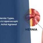 Understanding Hernia Types, Symptoms, Risks & Laparoscopic Treatment by Dr. Achal Agrawal