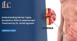 Understanding Hernia Types, Symptoms, Risks & Laparoscopic Treatment by Dr. Achal Agrawal