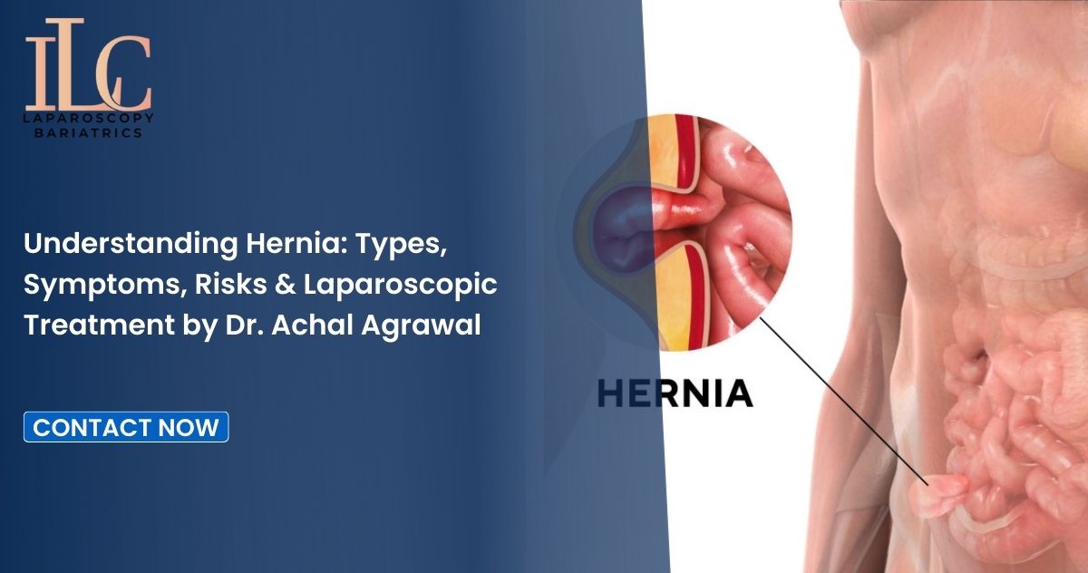 Understanding Hernia Types, Symptoms, Risks & Laparoscopic Treatment by Dr. Achal Agrawal