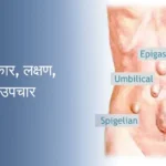 Hernia Types, Symptoms, Causes & Treatment
