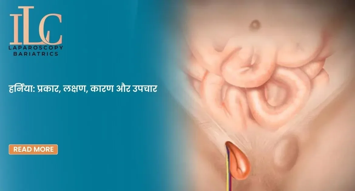 हर्निया प्रकार, लक्षण, कारण और उपचार