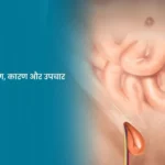 हर्निया प्रकार, लक्षण, कारण और उपचार