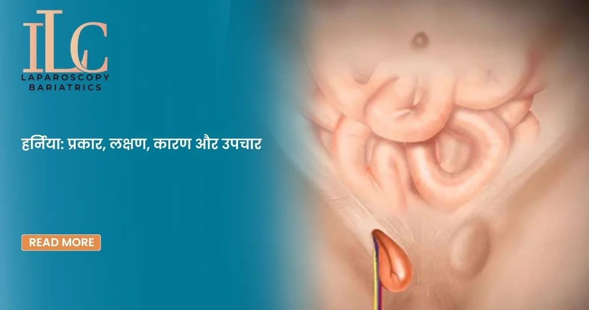 हर्निया प्रकार, लक्षण, कारण और उपचार